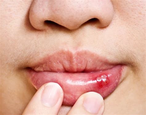 What Is Blood Blister In Mouth Causes And Treatment