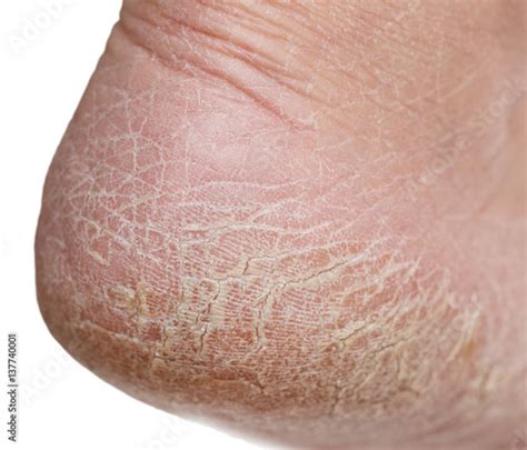 Dry Skin On The Legs With Cracks Acheter Cette Photo Libre De Droit