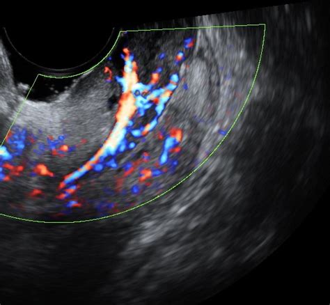 Cervical Polyp On Ultrasound