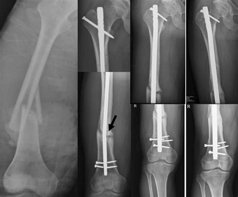 A 34 Year Old Man Sustained A Right Distal Femoral Shaft Comminuted