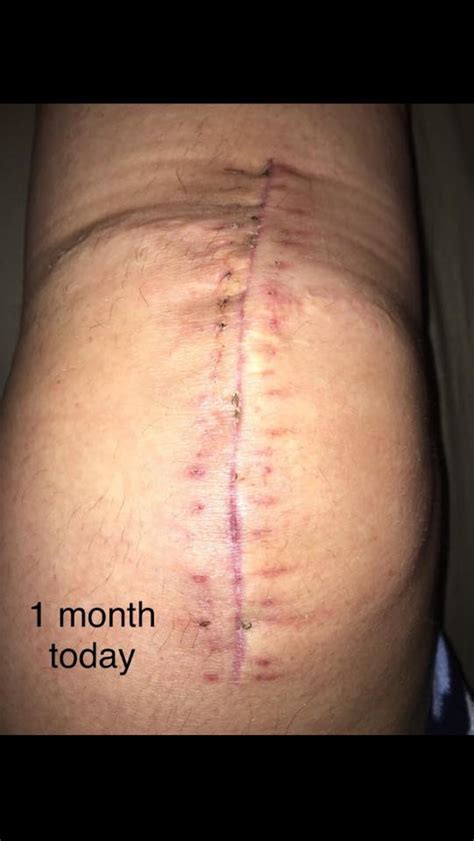 In the vast majority of cases, it enables people to live richer, more sometimes, however, the knee remains stiff. Knee Replacement Scar Recovery Timeline: A Photo Gallery