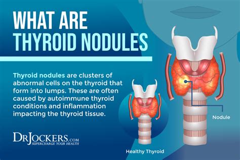 Thyroid Nodules Symptoms Causes And Support Strategies In 2021