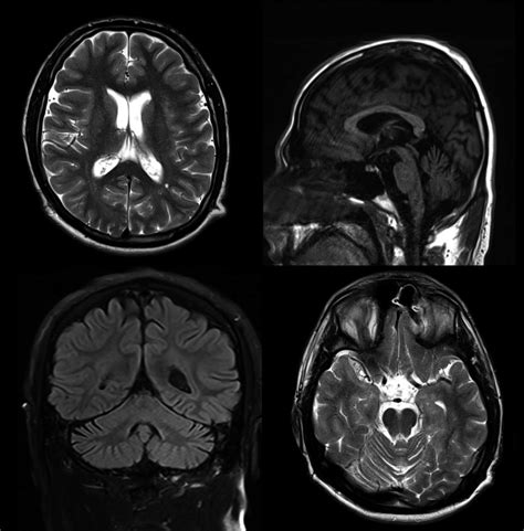 Mri Imaging Of Patient 1 Demonstrates Mild Cerebellar Atrophy With
