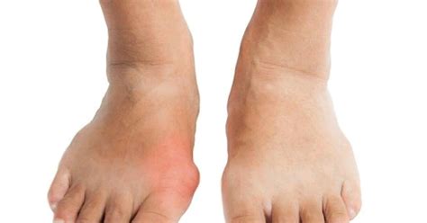 Bila dibiarkan, kondisi ini bisa menyebabkan gout kronis pada penderitanya. Ternyata Tak Sama, Kenali Dari Sekarang Perbedaan Penyakit ...