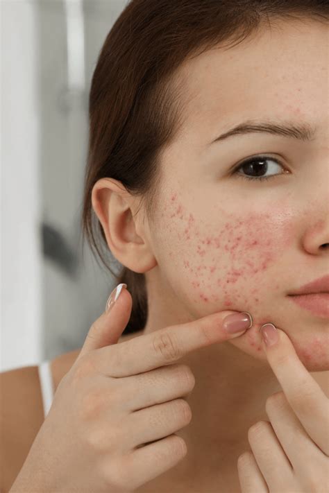 Natural Skin Care For Acne Naturally Created 4 You
