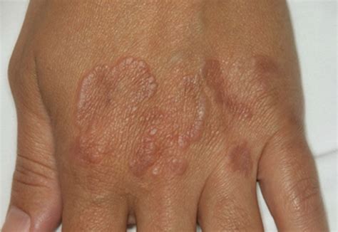 Granuloma Annulare Pictures Causes Contagious Symptoms Treatment