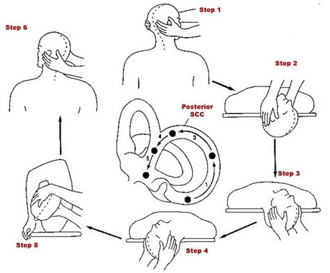 How To Safely Perform Epley Maneuver Home For Bppv Canalith Porn Sex