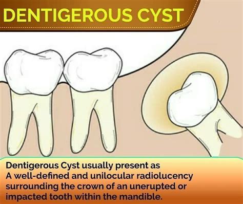 Teethfaq Posted To Instagram A Dentigerous Cyst Is An Odontogenic