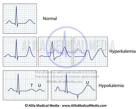 Hyperkalemia And Hypokalemia Ecg Changes Images And Photos Finder