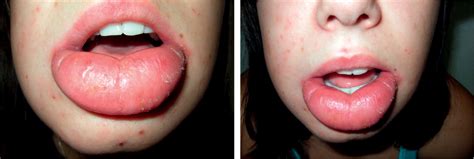 what causes sudden swelling of the lower lip