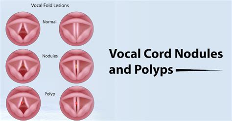 Vocal Cord Cysts And Polyps Vikram Ent Hospital And Research Institute