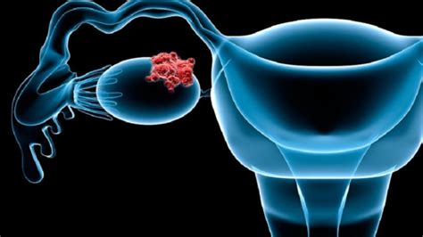 Waspada Kanker Ovarium Penyakit Yang Rentan Dialami Wanita