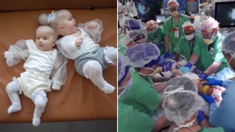 Conjoined Twins Fused Head Successfully Separated 24 Hour Surgery