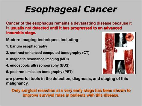 Ppt Esophageal Cancer Powerpoint Presentation Free Download Id5735568