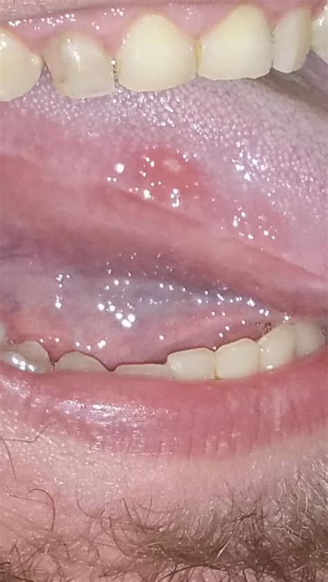 Red Painful Bump On The Side Of My Tongue Dentistry