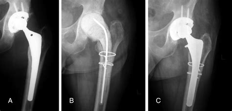 Use Of The Extended Trochanteric Osteotomy In Treating Prosthetic Hip