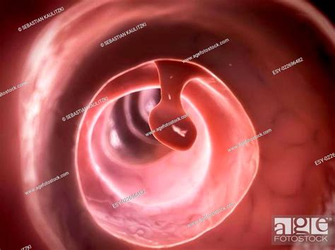 3d Rendered Illustration Of A Colon Polyp Stock Photo Picture And Low