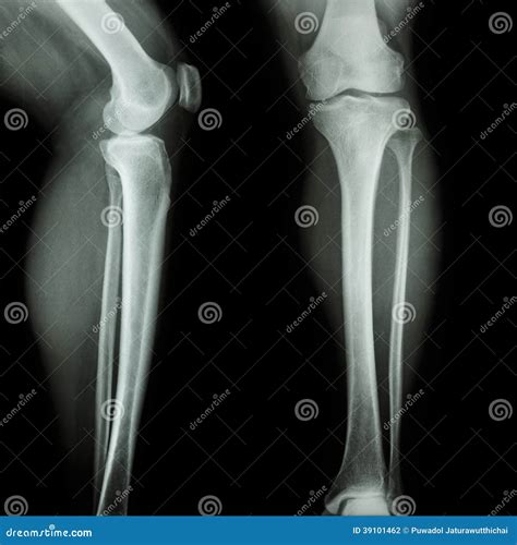 Film X Ray Leg And Knee Aplateral Stock Photo Image 39101462