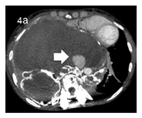 Postcontrastarterial Phase A And Oblique Reformatting B Showing A