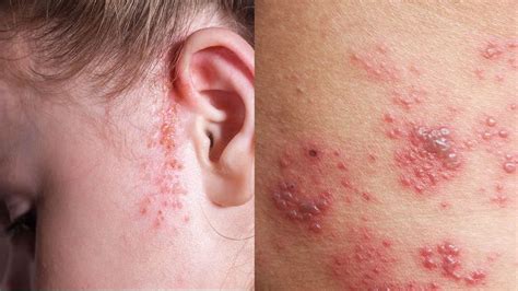 8 Common Types Of Rashes Kulturaupice