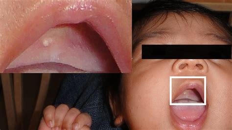 Z Str Ka Radioaktivn Tepl White Spots On Baby Gums Teething Koryto