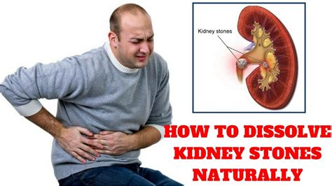 The Kidney Stone Removal Report Review How To Dissolve Kidney Stones