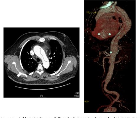 Figure 1 From Unusual Presentation Of Aortic Dissection With Bilateral