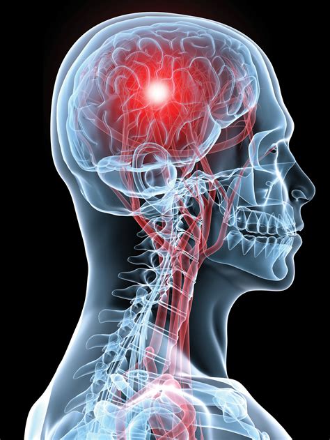 Conozca las señales y síntomas del accidente cerebrovascular Sentara Martha Jefferson Magazine