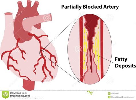 Coronary Artery Spasm Royalty Free Stock Photography