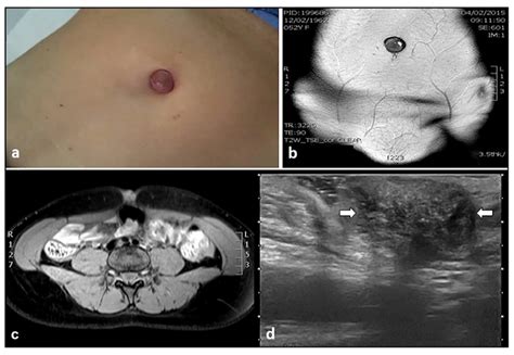 Diagnostics Free Full Text Ultrasound Imaging Of Abdominal Wall Endometriosis A Pictorial