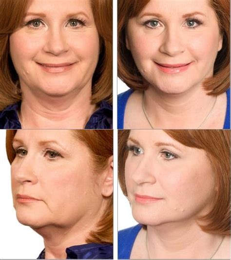 Collection by glenda swindle • last updated 5 days ago. Sagging neck and jowls- Sherrie, age, 55 had the Lifestyle Lift face and neck firming procedures ...