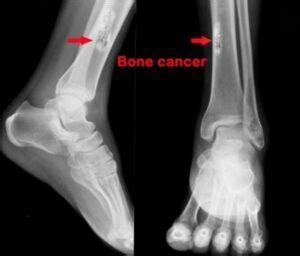Foot melanoma refers to cancer of the cells in the top layer of the skin on the foot. Acupuncture for Bone Cancer - The Acupuncture Clinic
