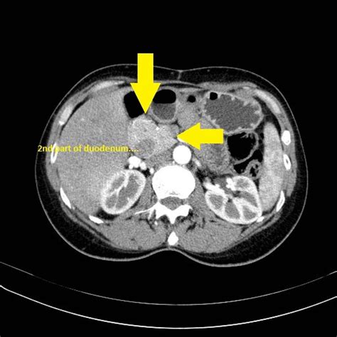 Can Pancreatic Cancer Be Missed On A Ct Scan Ct Scan Machine My Xxx