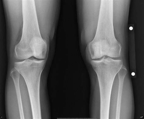 Articular Cartilage Defects Of Knee Knee And Sports Orthobullets