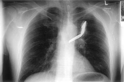 Penetrating Stab Injury Of The Thoracic Aorta Circulation