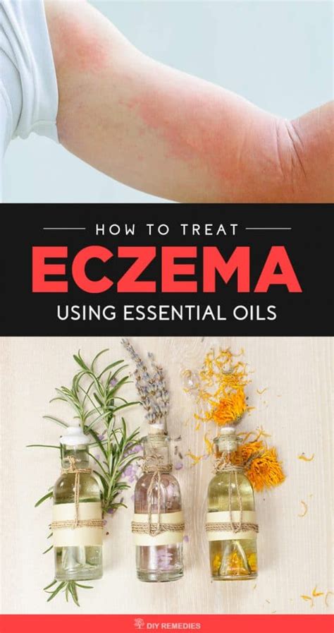 How To Treat Eczema Using Essential Oils