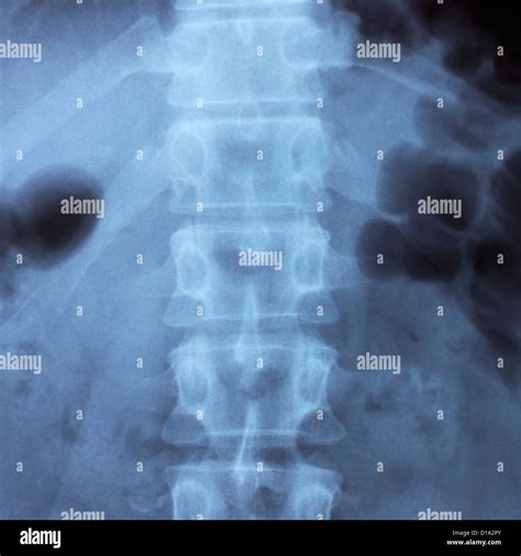 Radiografía De La Columna Vertebral Humana Fotografía De Stock Alamy