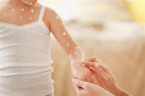 Chickenpox is caused by the contagious varicella virus and mainly affects children. Poxclin - Chicken Pox Treatment