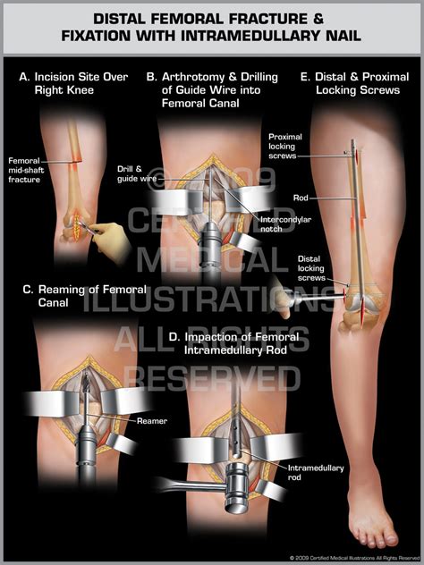 Distal Femoral Fracture And Fixation With Intramedullary Nail