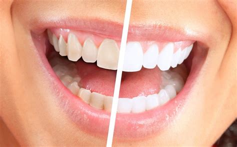 Best Teeth Whitening Kit Products In 2018