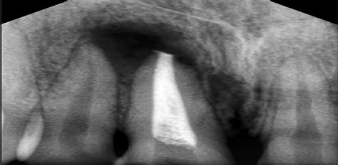 Single Visit Apexification In Immature Necrotic Teeth Using Srm