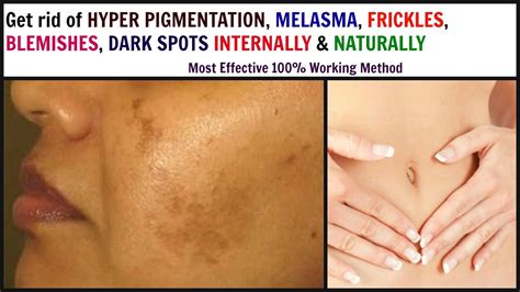 How To Cure Hyper Pigmentation Internally And Naturally झाइयों को