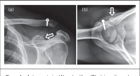 Figure 1 From Recurrent Acromioclavicular Joint Dislocation With An