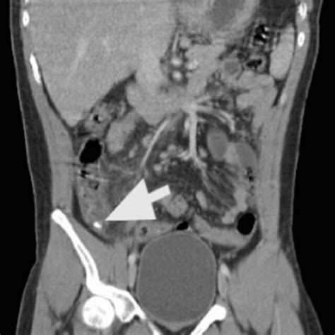 Contrast Enhanced Ct Of The Abdomen And Pelvis Showing Acute