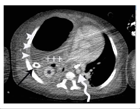 Axial Contrast Enhanced Computed Tomographic Image Of The Chest Showing