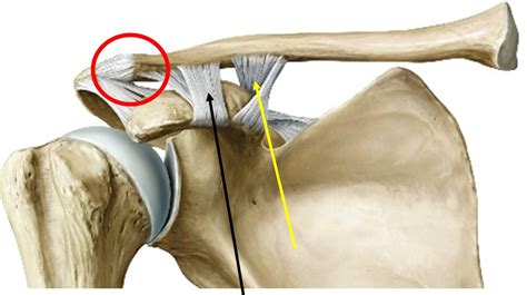 Acromioclavicular Ligament Between Acromion Process Of Scapula And