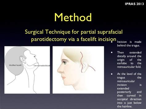 Partial Superficial Parotidectomy In Parotid Benign Tumor Ipras