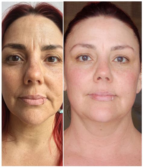 Before And After Photos Bloom Accupuncture Facial Rejuvenation