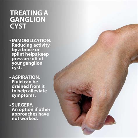 Ganglion Cyst Treatment Florida Orthopaedic Institute