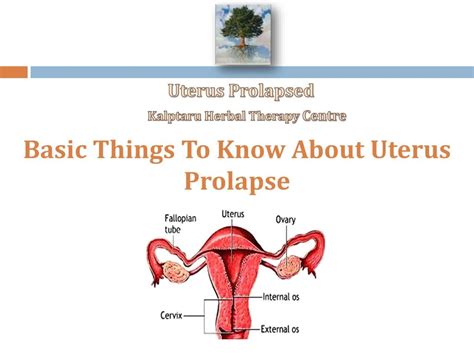 Uterus Prolapse Telegraph
